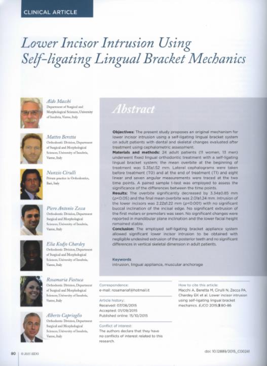 Lower incisor intrusion using Self-lifting Lingual Bracket Mechanics