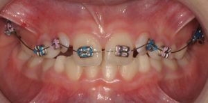 Arco di utilità superiore appoggiato su denti da latte e denti permanenti