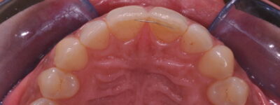 MAC ortodonzia mini invasiva