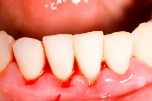 gengive arrossate dentista problema