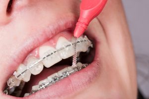 Uso dello scovolino in ortodonzia