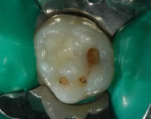 Otturazione dente da latte 3- rifinitura delle cavità