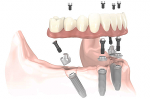 Implantologia guidata clinica dentale caprioglio pavia
