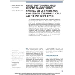 Guided eruption of palatally impacted canines through combined use of 3-dimensional computerized tomography scans and the easy cuspid device