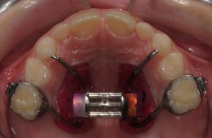 Espansore rapido palatale di Haas bondato su denti decidui