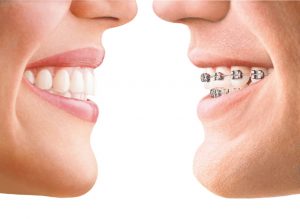 Invisalign 1 ortodonzia invisibile