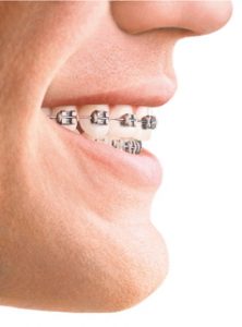 Ortodonzia fissa 1