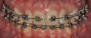 Ortodonzia fissa 2