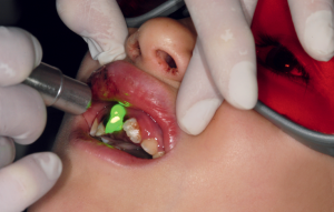 Laser DEKA KTP per ridurre il dolore post trauma