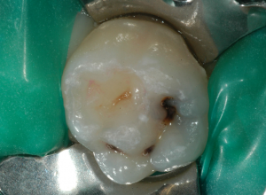 Otturazione dente da latte 1 - situazione iniziale