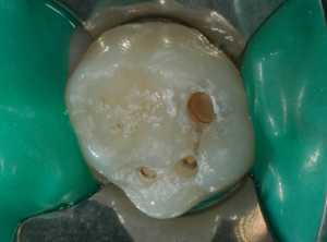 Otturazione dente da latte 2 - preparazione delle cavità