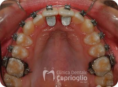 MORSO PROFONDO 2 CASO CLINICO CAPRIOGLIO