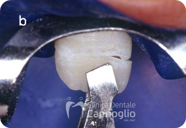 Frattura coronale complessa2
